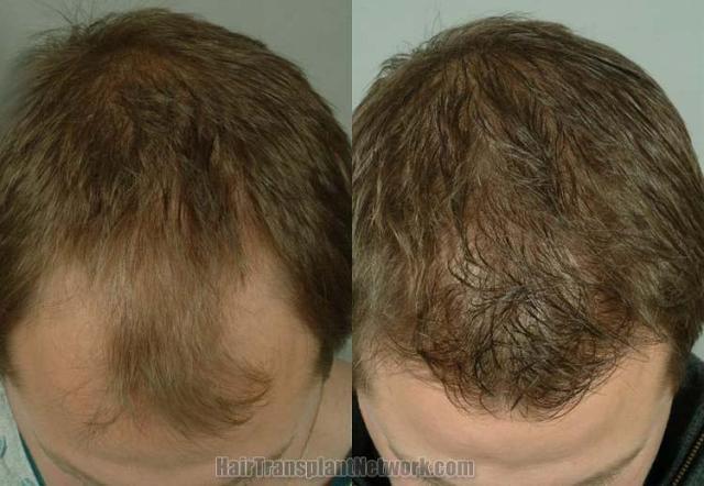 Before and after hair transplant procedure images