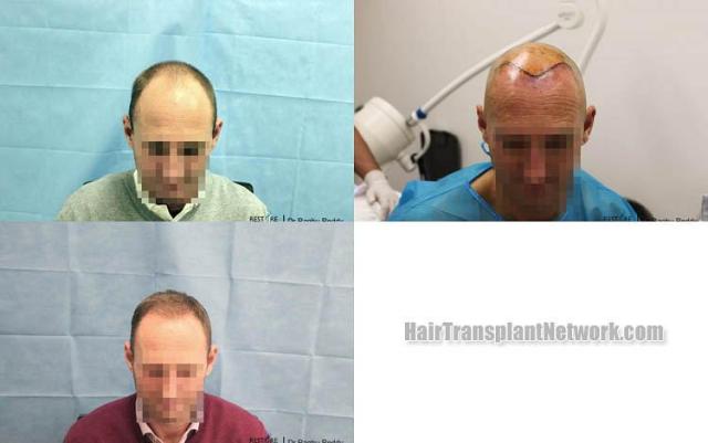 Hair transplantation surgery before and after photos