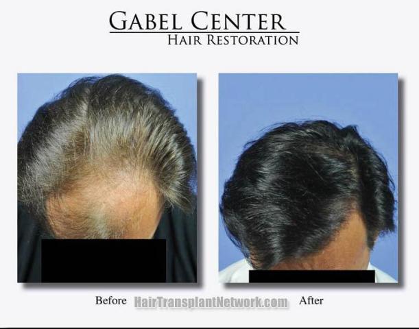 Hair transplantation surgery before and after photos