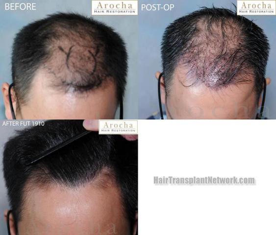 Hair transplantation surgery before and after photos