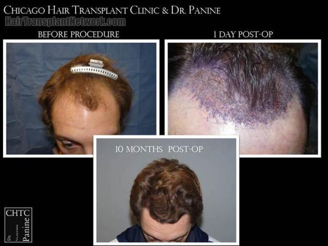 Top view - Before and after surgical hair replacement