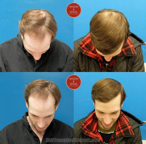 Hair transplantation surgery before and after photos