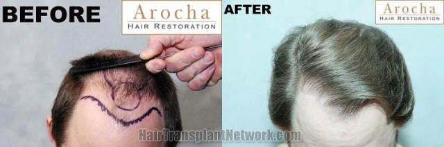 Top view before and after hair restoration results