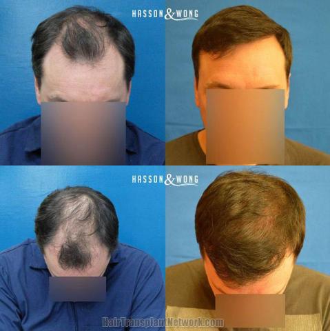 Hair transplantation surgery before and after photos