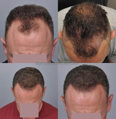 Hair transplantation surgery before and after photos