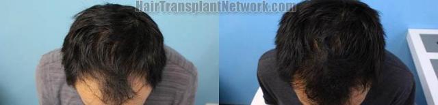 Hair restoration procedure before and after results