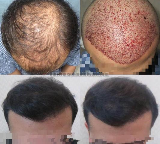 Hair transplantation surgery before and after pictures