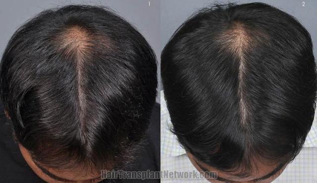 Top view before and after hair restoration results