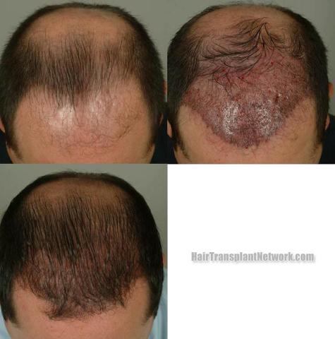 Hair restoration procedure before and after pictures