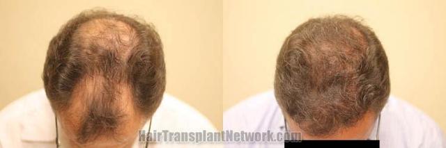 Hair restoration procedure before and after results