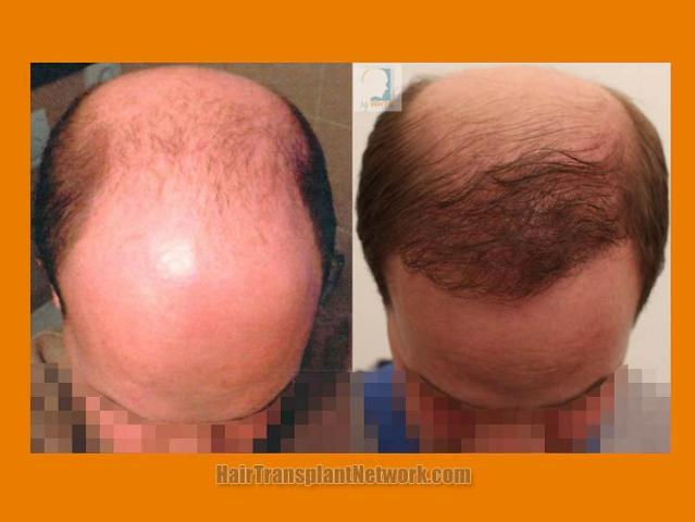 Before and after hair transplantation surgery