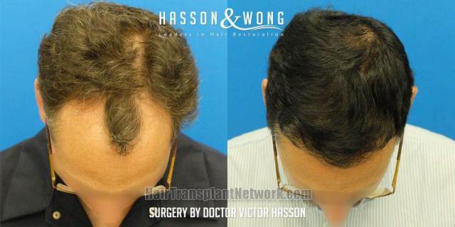 Before and after hair transplant procedure images