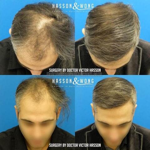 Before and after hair restoration procedure images