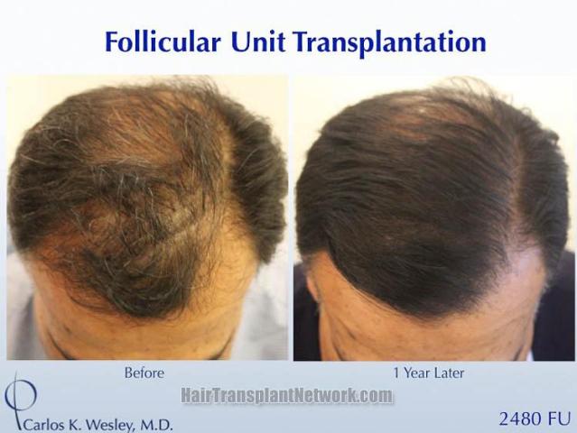 Top view - Before and after hair restoration procedure