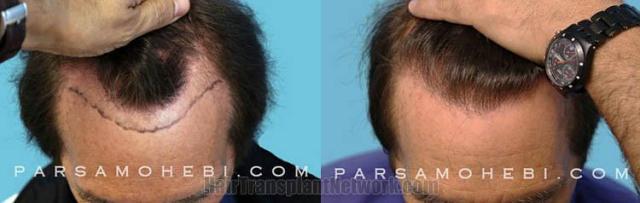 Top view - Before and after hair restoration procedure