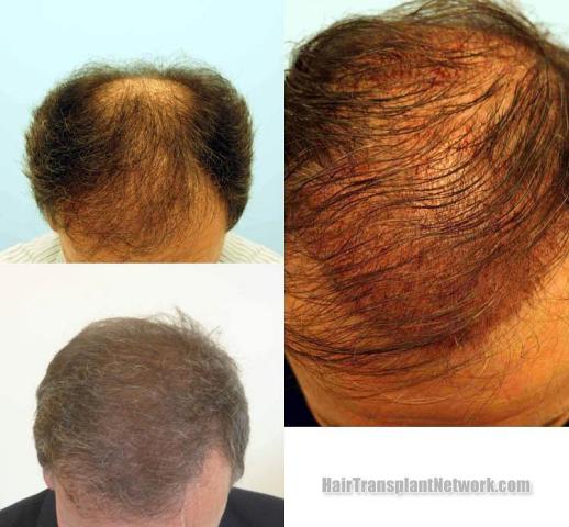 Before and after hair restoration procedure images