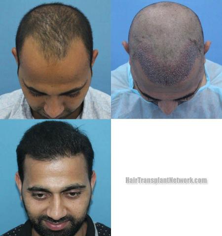 Hair restoration procedure before and after results