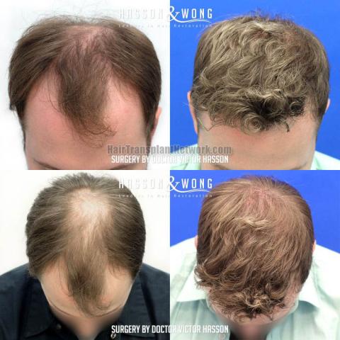 Before and after hair restoration procedure images