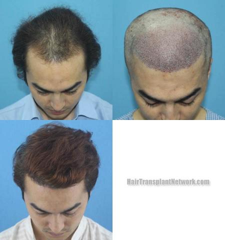 Hair transplantation surgery before and after images