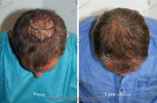 Hair restoration procedure before and after results