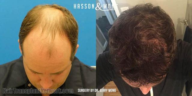 Hair restoration procedure before and after pictures