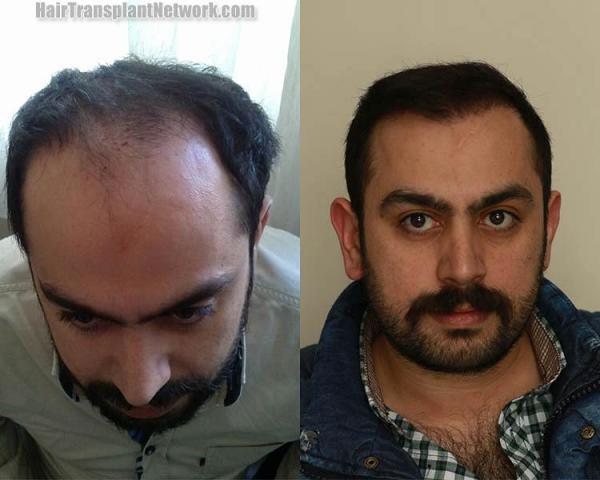 Hair restoration surgery before and after images