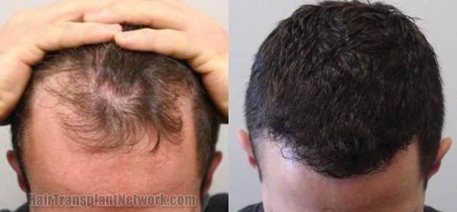 Before and after hair transplant procedure images