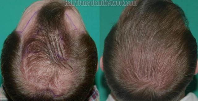 Hair restoration procedure before and after pictures