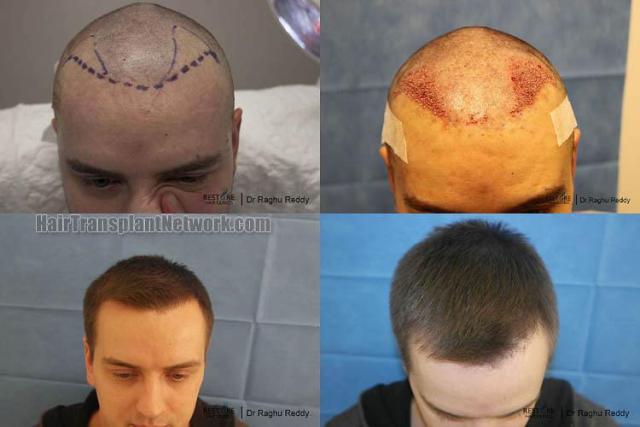 Before and after hair transplant procedure images