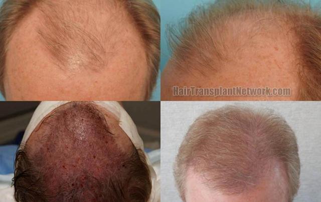 Hair transplantation surgery before and after photos