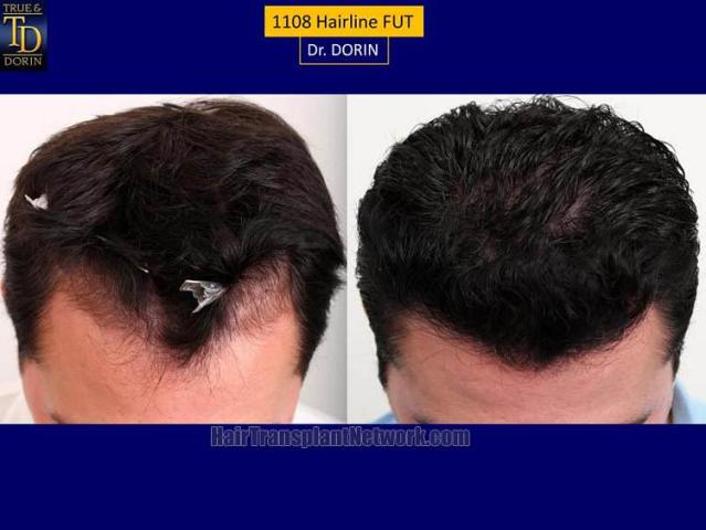 Hair transplantation surgery before and after photos