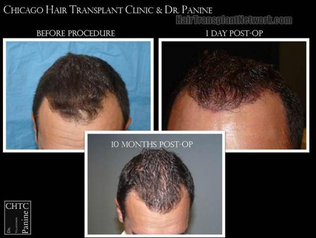 Hair transplantation surgery before and after photos