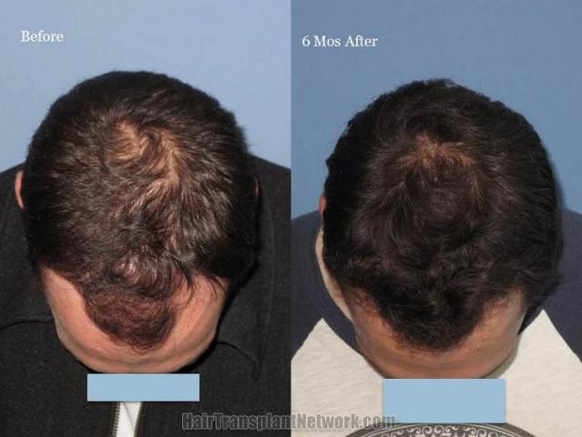 Before and after hair transplantation result photographs