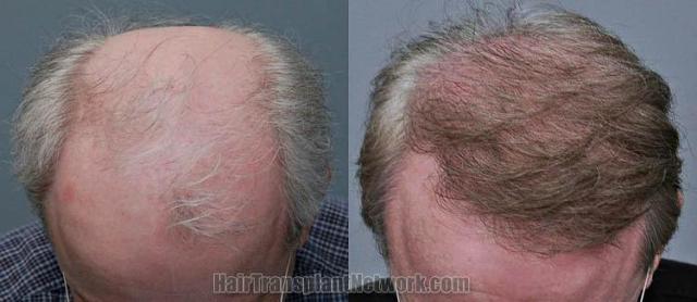 Top view - Before and after surgical hair replacement