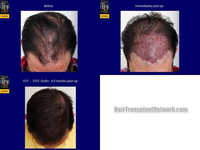 Hair transplantation surgery before and after photos