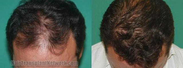 Hair transplantation surgery before and after images