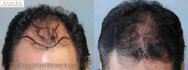 Hair restoration procedure before and after results