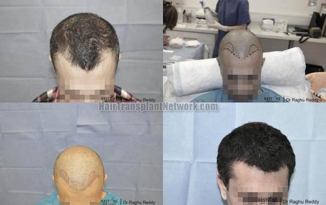 Hair transplantation surgery before and after photos