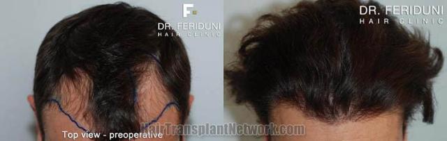 Hair transplantation surgery before and after photos