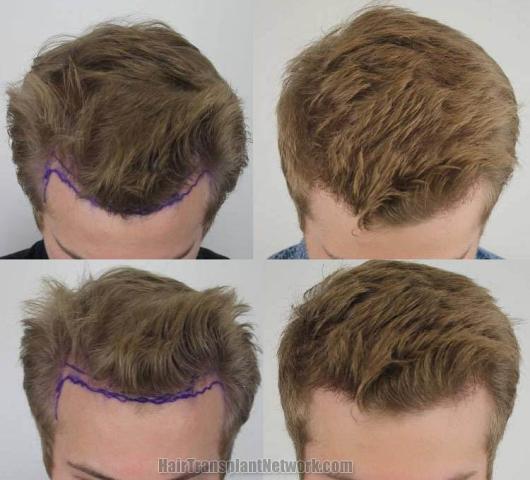 Hair transplantation surgery before and after photos