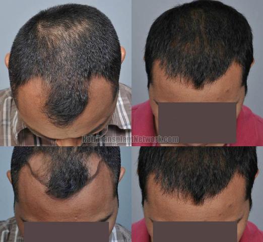 Hair transplantation surgery before and after photos