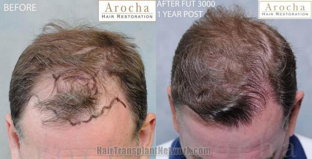 Hair transplantation surgery before and after photos