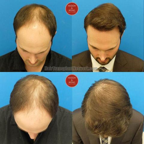 Top view - Before and after surgical hair replacement