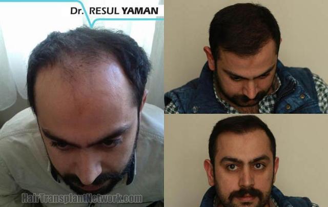 Hair transplantation surgery before and after photos