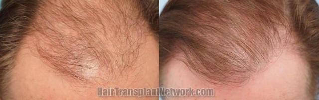 Hair restoration procedure before and after results