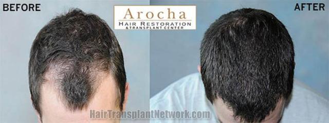 Hair transplantation surgery before and after images