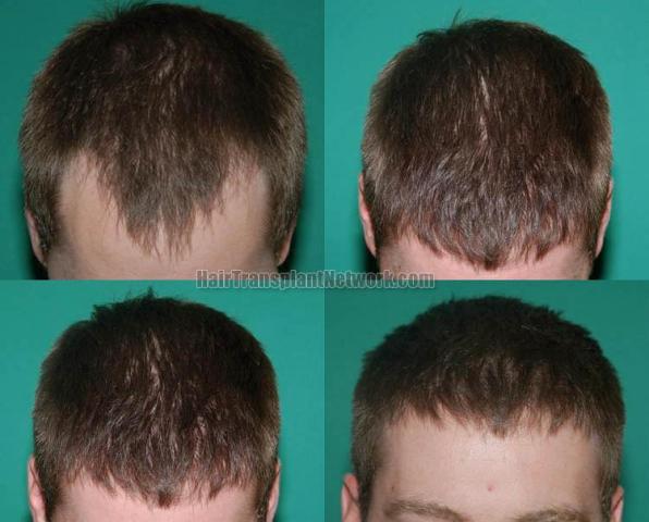 Hair transplantation surgery before and after pictures