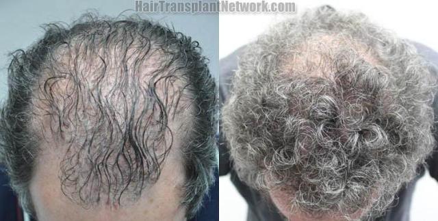 Top view before and after hair restoration results