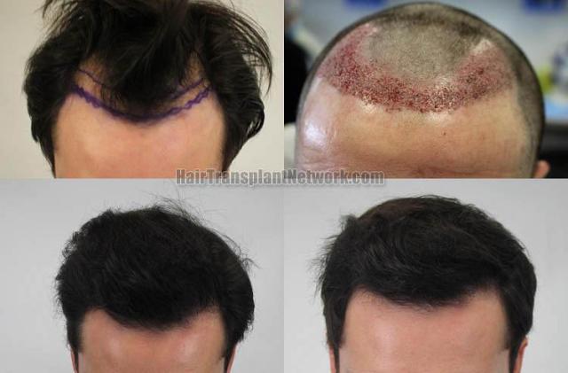 Hair restoration procedure before and after results