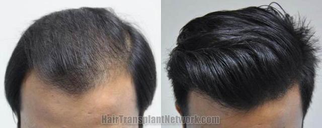 Hair restoration procedure before and after results